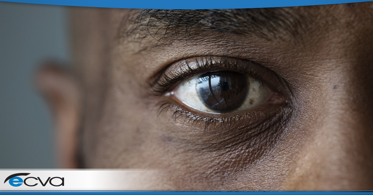 close up of a African American male with a blood vessel in his eye