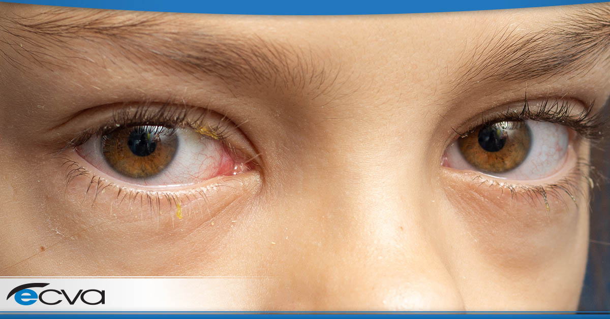 Pediatric Conjunctivitis (Pink