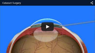 Cataract Surgery provided by ECVA Eye Care