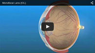 Monofocal Lens IOL for Astigmatism provided by ECVA Eye Care