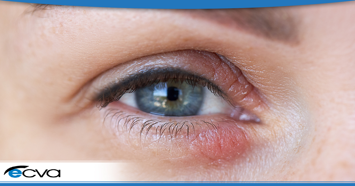 What Is Eyelid Dermatitis