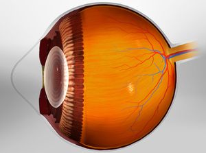 keratoconus_300