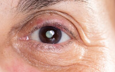 6 Early Warning Signs of Cataracts